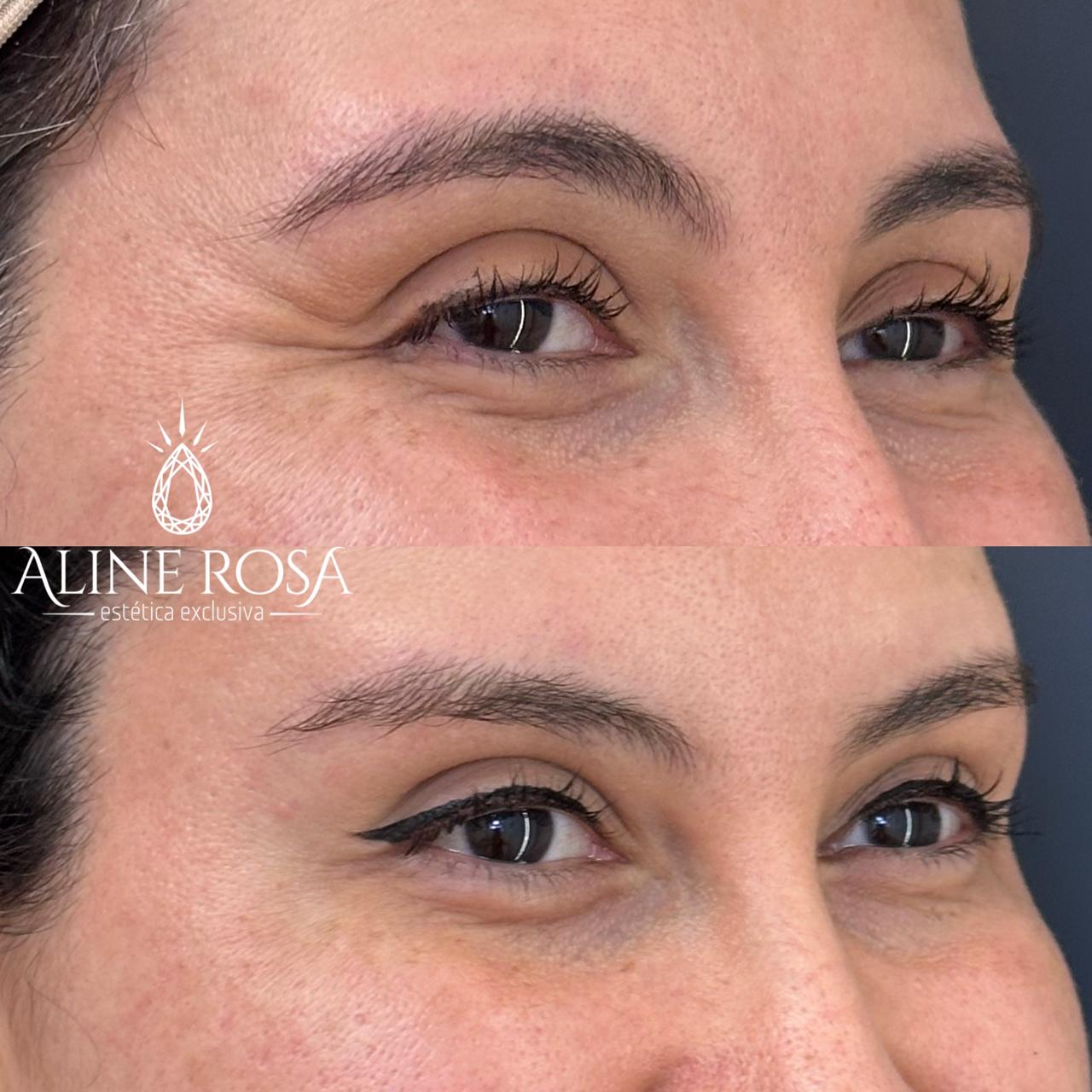 Botox Terço Superior Feminino